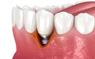 Periimplantitis: causas, síntomas y tratamiento explicado por expertos