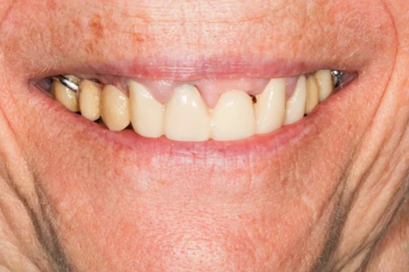 sonrisa real paciente dentadura estado general fisiodent san blas servicios dentales