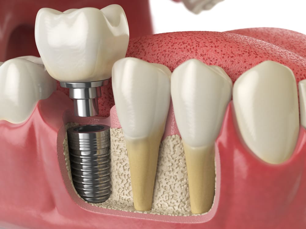 evaluacion del hueso maxilar y diagnostico para colocacion de protesis y coronas